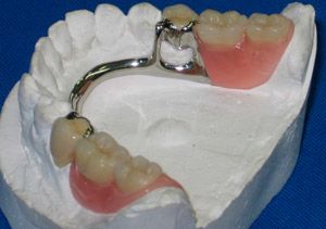 Laboratorio Dental Luan prótesis mixta