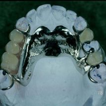 Laboratorio Dental Luan implantes metálicos
