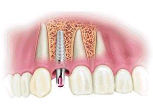 Laboratorio Dental Luan implantes